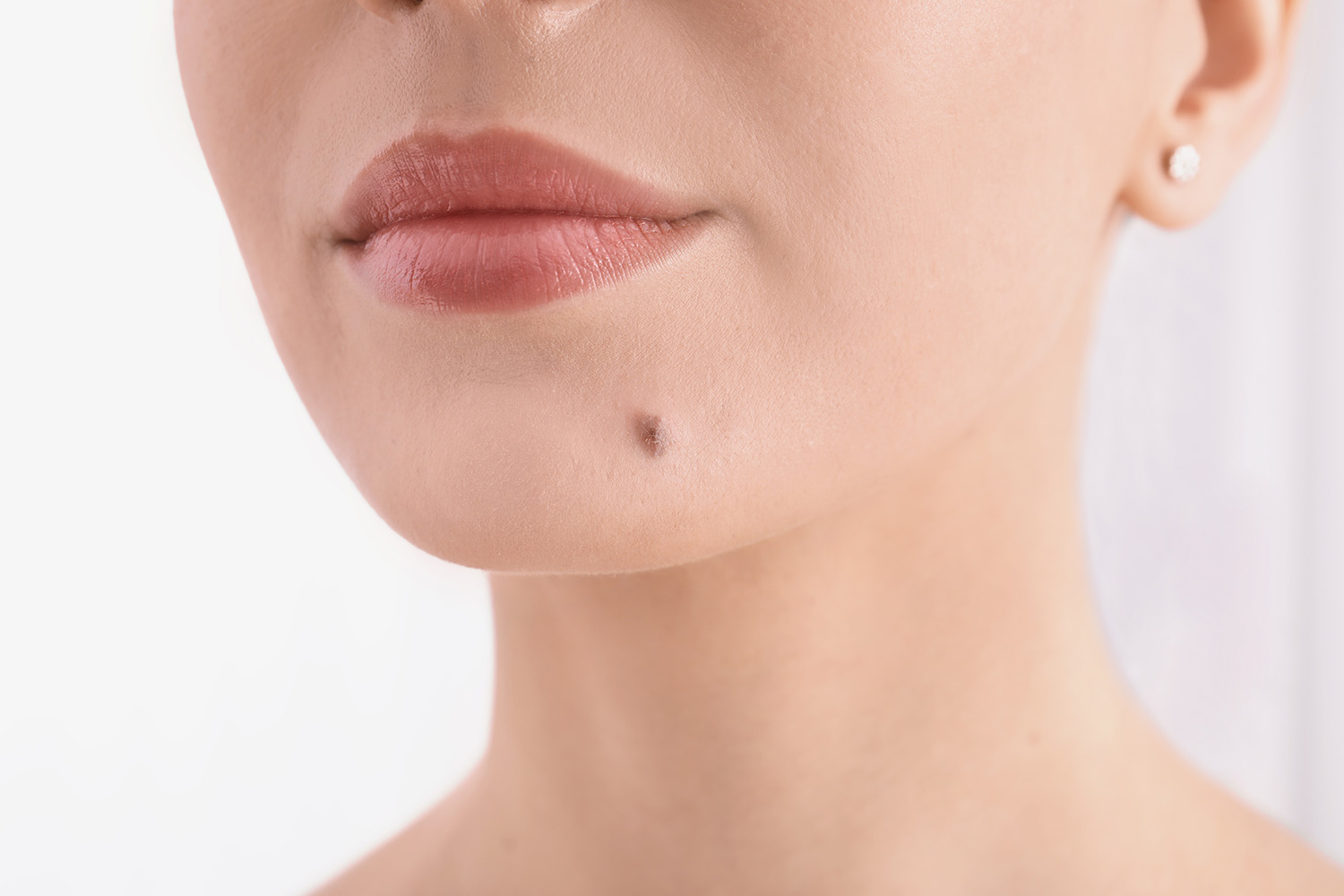 MVZMKG Mund-Kiefer-Gesicht-Chirurgie - Hauttumore entfernen